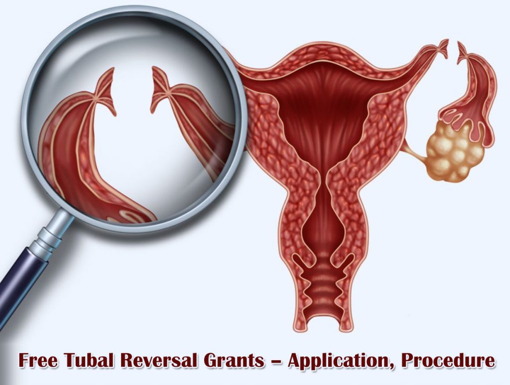 Free Tubal Reversal Grants – Application, Procedure